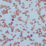 Sickle cell: India Highlights Healthcare Progress at UNGA81 sickle-cell-91131